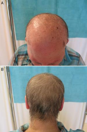 A) Alopecia a nivel frontal y parietal, con pelos aislados e hiperqueratosis folicular. B) Persistencia de pelo de área occipital.