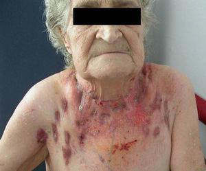 paciente afectada por escrofulodermia (archivo fotográfico del Hospital Parc Taulí, Sabadell, Barcelona), referida en la cantiga 321 como «lamparones».