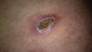 Patch with a necrotic central area and erythematous border on the abdomen.