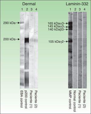 Técnica de inmunoblot realizada con extractos dérmicos de piel humana, obtenidos mediante piel separada con ácido tetracético etilendiamina y sometidos a electroforesis en gel de SDS-poliacrilamida, según el método de Laemmli (izquierda), así como inmunoblot con laminina 332 recombinante (derecha). En la parte izquierda (extractos dérmicos de piel humana) se observa que los sueros de los pacientes 1 y 2 (corresponden a las columnas 3 y 4 respectivamente) reconocen una banda de 200kDa que se corresponde con la misma banda que detecta el suero de otro paciente con penfigoide anti-p200 (columna 2), mientras que el suero de un paciente con epidermólisis ampollosa adquirida (columna 1) no detecta dicha banda, pero sí una de 290kDa, correspondiente al colágeno vii. En la parte derecha (laminina 332 recombinante) se observa que el suero de los pacientes 1 y 2 (columnas 3 y 4), al igual que el suero control sano (columna 2), no detectan la proteína recombinante, mientras que el suero de un paciente con penfigoide anti-laminina 332 (columna 1) detecta varias bandas de 165, 145, 140 y 105kDa, que corresponden a las cadenas α3, β3, y γ2 de la laminina 332, respectivamente.