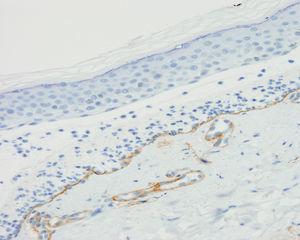 En el estudio inmunohistoquímico con colágeno iv se observa la tinción de la parte dérmica de la ampolla, que demuestra que esta se encuentra por encima de la lámina densa, así como de la pared de los vasos dérmicos (colágeno iv ×200).