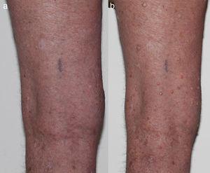 (a) Baseline photo prior to starting BRAFi and (b) multiple VKs on bilateral lower limbs 5 weeks post starting BRAFi.