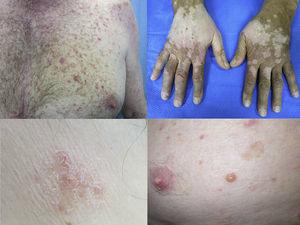 Anti-CTLA4 induced (a) maculopapular exanthema, (b) vitiligo, (c) anti-PD1 induced eczema and (d) bullous pemphigoid.
