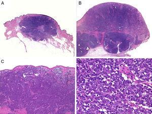 Estudio histológico. A y B: panorámica de un carcinoma de células de Merkel. Tumor bien delimitado, no encapsulado, nodular (A y B:hematoxilina-eosina, x10). C: tumor localizado en la dermis constituido por células redondas, basófilas y monomorfas (hematoxilina-eosina, × 100). D: las células son redondas, azules, con escaso citoplasma y núcleo con cromatina fina y granular. En el tumor se observan numerosas figuras mitósicas (hematoxilina-eosina, × 400).