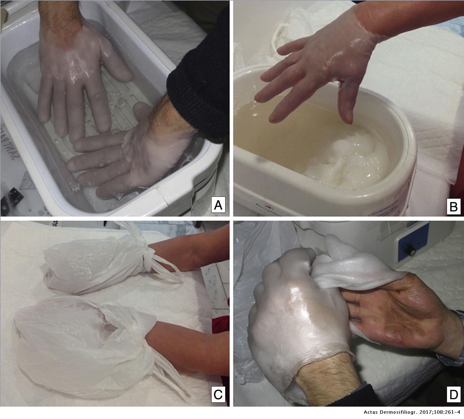Contrato portátil Lleno Baños de parafina para el tratamiento del eccema crónico de las manos |  Actas Dermo-Sifiliográficas