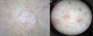 Dermoscopic images of disseminated superficial actinic porokeratosis. (A) Patient 5, with a scar-like area. (B) Patient 6, who presented central atrophy with irregular vessels and a hyperkeratotic border.
