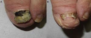A) Onicoclasis y onicomadesis con pigmento negruzco de fondo en el lecho ungueal. B) Anoniquia parcial residual con desaparición casi completa del pigmento.