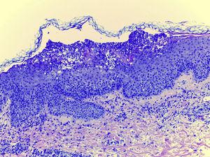 Histopathology. HE 10×. Neutrophilic spongiotic subcorneal pustules. Perivascular infiltrate with lymphocytes and eosinophyles.
