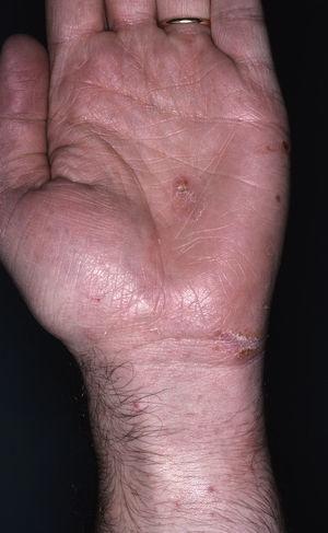 Scabietic burrows and nodules in volar surface of the wrists.