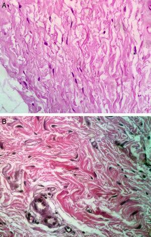 Corte histológico con aumento 40x y con tinción de hematoxilina y eosina. Se observa el incremento en el número de fibroblastos al comparar los cortes de las biopsias anterior (A) y posterior al tratamiento (B).