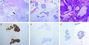 A) Muestra de piel, desprovista de epidermis. Se observan anejos cutáneos normales en relación con tumor mucinoso (flecha) (H&E, ×2); B) Detalle del tumor con lagos de mucina que contienen nidos tumorales, en áreas de aspecto cordonal y cribiforme (H&E, ×10); C) Tinción de PAS positiva en los lagos de mucina (×10); D) positividad intensa y difusa para CK7 en las células neoplásicas (×10); E) Negatividad para CK20 (×10); F) Dos microfotografías que muestran el detalle de la positividad nuclear para p63 en aisladas células dentro de los nidos tumorales, que corresponden a un componente mioepitelial detectable en el tumor, favoreciendo origen cutáneo del mismo (×20).