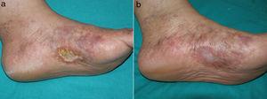 a) Úlcera cutánea en cara medial del pie izquierdo sobre un fondo de livedo racemosa y púrpura retiforme. b) Atrofia blanca secundaria a la cicatrización tras el uso de rivaroxabán oral.