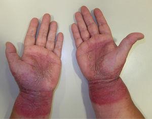 Patrón en agarre palmar. Nótese la afectación de las muñecas que orienta hacia una dermatitis de contacto alérgica.