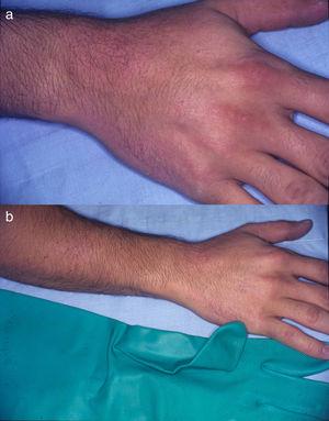 Dermatitis de contacto alérgica con patrón en guantes. a) y b) Placas de eccema de distribución parcheada afectando el dorso de la mano derecha y el antebrazo en un paciente con dermatitis de contacto alérgica por tiuram en guantes de goma.