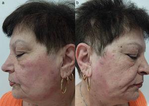 a) y b) Dermatitis de contacto alérgica por champú afectando ambos lados de la cara (patrón del lavado).