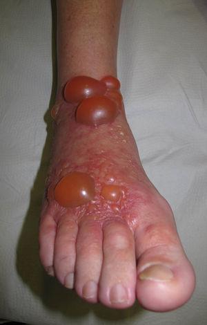 Dermatitis de contacto fotoalérgica por antiinflamatorios tópicos.