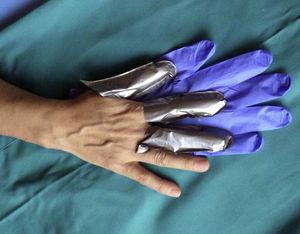 Correcta protección de la mano dominante con dediles de guantes 4H®. Encima se deben poner guantes de nitrilo para mantener los dediles en el sitio y favorecer la destreza para este tipo de tarea.