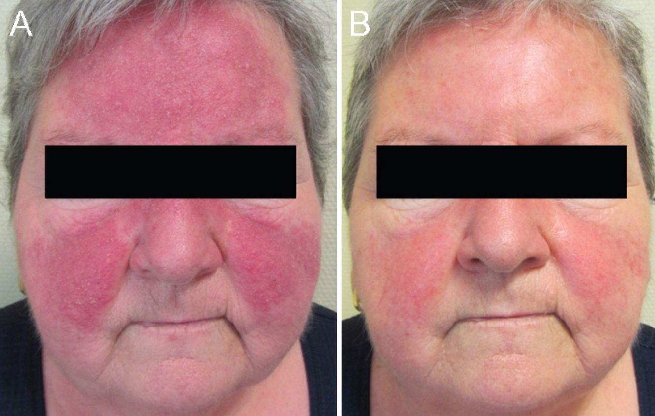 Accutane 40mg Online