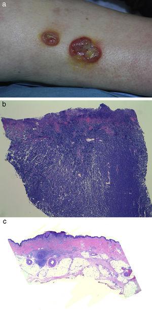 Caso 2. a) Aspecto clínico del carcinoma de células de Merkel en la región pretibial mostrando 2lesiones tumorales ulceradas. b) Imagen histológica de la biopsia inicial de uno de los tumores pretibiales mostrando una densa proliferación dérmica de células basofílicas (hematoxilina-eosina×40). c) Imagen histológica a pequeño aumento de uno de los tumores pretibiales tras su regresión mostrando intensa fibrosis residual y un infiltrado linfoide acompañante. En la base de la úlcera proximal se detectó únicamente un nido tumoral de 2,5mm formado por células basofílicas (hematoxilina-eosina×20).