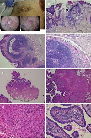Nevus sebáceo que asocia un tricoblastoma, un siringocistoadenoma papilífero y un triquilemoma. A)Imagen clínica y dermatoscópica del hamartoma y las lesiones asociadas. B(HE, 4×): imagen histológica del nevus sebáceo, correspondiente a la parte más aplanada de la lesión. C(HE, 4×): imagen histológica de un tricoblastoma, que corresponde a la zona papular más oscura. D(HE, 10×): detalle del tricoblastoma. E(HE, 2×): imagen histológica panorámica correspondiente a la pápula menos pigmentada, que fue diagnosticada de un triquilemoma bajo un siringocistoadenoma papilífero. F(HE, 4×): detalle del triquilemoma. G(HE, 10×): detalle de triquilemoma a mayor aumento. H(HE, 10×): detalle del siringocistoadenoma papilífero.
