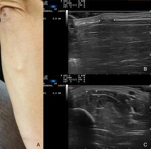 A) Nódulo en el borde cubital del antebrazo derecho. B y C) Ecografía modo B: entre marcadores se aprecia discontinuidad de la fascia muscular. B) Corte longitudinal. C) Corte transversal.