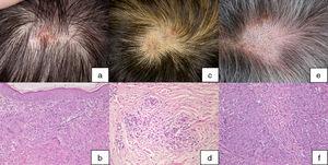 Características clínicas e histológicas de la sarcoidosis del cuero cabelludo (a y b: caso 1; c y d: caso 2; e y f: caso 3). Tinción hematoxilina-eosina, ampliación del original ×200.