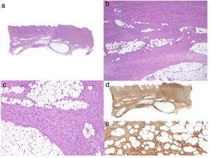 Histología típica de un dermatofibrosarcoma protuberans.a: Panorámica con hematoxilina eosina; b y c: infiltración dérmica e hipodérmica por el tumor; d: panorámica de la tinción intensamante positiva con CD34; e: detalle de las células fusiformes entre los adipocitos que muestran tinción intensa de CD34.