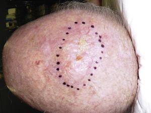 Sarcoma pleomórfico dérmico localizado en cuero cabelludo en un paciente anciano. Tumoración mal delimitada en forma de placa infiltrada.
