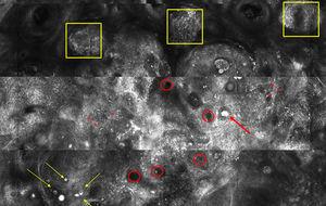 Imagen de microscopía confocal de 2,2×1,4mm. Se observan sebocitos pequeños inmaduros que forman nidos basalioides (recuadro amarillo), escasos sebocitos grandes maduros salpicados (flecha amarilla), conductos sebáceos (círculo rojo), quistes córneos (flecha roja) y abundantes macrófagos (asterisco rojo).
