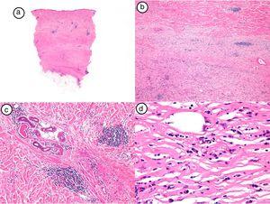 Hallazgos histológicos de la biopsia del caso número 4. a) Imagen panorámica con una dermis muy engrosada y poco tejido celular subcutáneo (HE, x4). b) Detalle del engrosamiento de los haces de colágeno (HE, x40). c) Detalle del infiltrado inflamatorio perianexial (HE, x40). d) Células plasmáticas y linfocitos como componentes fundamentales del infiltrado inflamatorio (HE, x40).