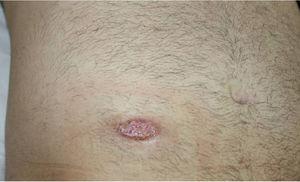 Rápida mejoría clínica de la úlcera inicial tras 3 semanas de tratamiento con prednisona oral.