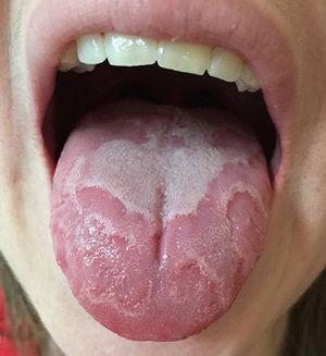 Placas eritematosas con un margen blanquecino bien definido localizadas en el dorso de la lengua.