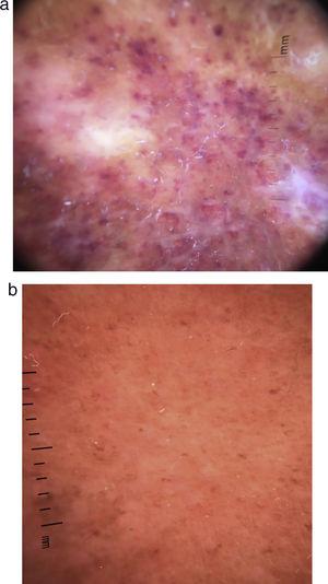a) Dermatoscopia lesión caso 2: puntos purpúricos finos y gruesos en un fondo rojo-anaranjado. b) Dermatoscopia lesión caso 4: puntos purpúricos finos en un fondo rojo-anaranjado. Aumento 40×. Tinción hematoxilina-eosina.