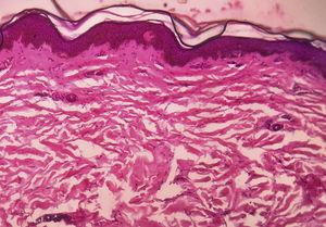 Aplanamiento de la epidermis con atrofia de las crestas epidérmicas y haces hialinos de colágeno densamente compactados con células inflamatorias dispersas en la dermis (H&E, ×10).
