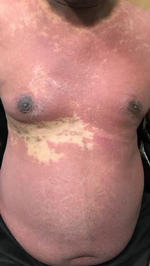 Lesiones máculopapulares eritematosas confluentes en el tórax y abdomen con preservación del dermatoma T9 derecho.