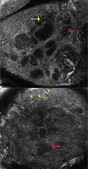 A) Dermatitis alérgica de contacto: imagen de microscopia confocal de reflectancia (0,5×0,5mm) a nivel de la capa espinosa (∼ 30 μs de profundidad) mostrando espongiosis y exocitosis (flecha amarilla) y múltiples microvesículas acompañadas de linfocitos y queratinocitos disgregados (flecha roja). B) Dermatitis irritativa de contacto: imagen de microscopia confocal de reflectancia (0,5×0,5mm): muestra disrupción del estrato córneo con presencia de corneocitos disgregados y paraqueratosis temprana (flecha amarilla) y confluencia de microvesículas con infiltración de células inflamatorias (flecha roja).