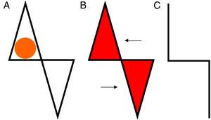 A. Defecto y diseño del colgajo. B. Exéresis de los triángulos y desplazamiento. C. Cierre, línea de sutura.