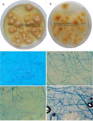 A-B. Cultivo de pelos y escamas en placas de agar Sabouraud cloranfenicol actidiona a los 15 días (28°C). Se observan colonias planas de borde estrellado, con micelio superficial blanco-lanoso en el anverso (A) y de color amarillo-anaranjado pálido en el envés (B). C-F. Morfología microscópica, tras 7 días en agar patata dextrosa.C: hifa pectinada (peine). D: clamidosporas intercalares (20X). E: macroconidio (20X). F: clamidospora terminal de M. audouinii (20X).