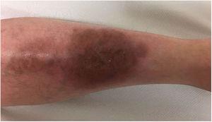 Lesión residual en pierna izquierda tras tratamiento con ustekinumab y ciclosporina durante 12 semanas.