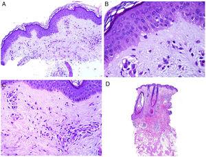 Afectación cutánea en un caso de lupus con manifestaciones sistémicas. Ausencia de atrofia epidérmica (A: H&E ×100). Existe muy poca degeneración vacuolar de la basal sin evidencia de engrosamiento de la membrana basal (B: H&E ×400). El infiltrado inflamatorio dérmico es discreto y puede contener neutrófilos (C: H&E ×200). D)En contraste, el lupus eritematoso discoide muestra dilataciones infundibulares, tapones córneos prominentes e infiltrado perianexial marcado (H&E ×20).
