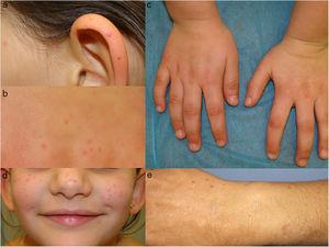 Lesiones papulosas eritematovioláceas, con halo periférico blanquecino en la paciente de 7 años (a-d). Paciente 2 con lesiones eritematosas en antebrazos (e).