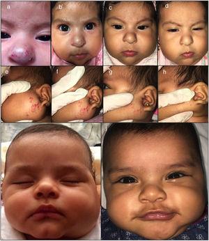 Fotografías clínicas de una niña de 2 meses de edad con un HI mixto nasal y de una niña de 4 meses de edad con un HI mixto parotídeo, tratadas con atenolol oral. Se muestran los cambios en el tamaño al inicio del tratamiento (a, e, i), en el mes 1 (b, f), a los 2 meses (c, g) y a los 4 meses (d, h, j).