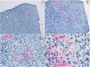 Inmunohistoquímica (anticuerpos antitreponema): positividad con presencia de espiroquetas en dermis papilar y porciones basales del epitelio. Tinción treponema: a) ×10, b) ×20, c) ×40 y d) ×100.