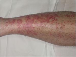 Enfermedad de Majocchi. Lesiones rojo-violáceas de morfología anular en extremidad inferior.
