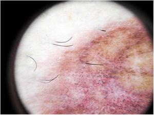 Dermatoscopia de liquen aureus. Fondo rojo-parduzco, con puntos grises y pseudorretículo pigmentado.