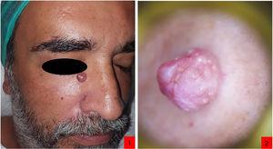 1) Nódulo rojo de superficie lisa en tercio superior del surco nasogeniano derecho; 2) Dermatoscopia. Lecho rojo-blanquecino con vasos telangiectásicos irregulares y áreas blanco-algodonosas.