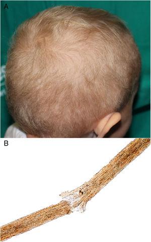 A) Pelo rubio de baja densidad, de aspecto seco y deslustrado. B) Foco de fractura transversal con los extremos deshilachados en el pelo de una niña tras 10 meses de tratamiento con trametinib.