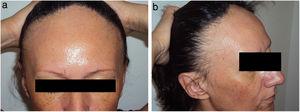 Mujer premenopáusica con alopecia frontal fibrosante: a) frontal; b) lateral (nótese la presencia de pápulas faciales).