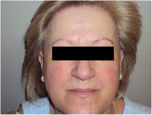 Mujer con alopecia frontal fibrosante y signos de rosácea.