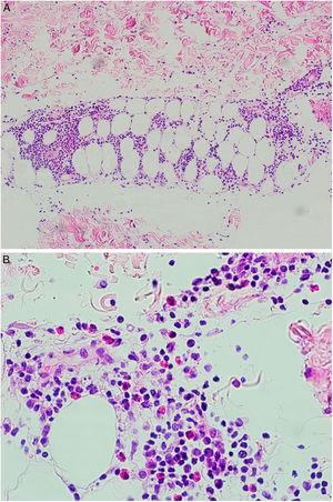 A) A mayor aumento se advierte un infiltrado en el tejido celular subcutáneo de patrón predominantemente lobulillar. B) El infiltrado está compuesto por linfocitos, histiocitos y numerosos eosinófilos.